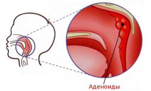 Как лечатся аденоиды у взрослых?