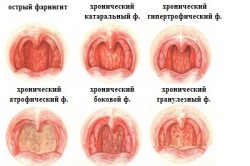 Формы фарингита Формы фарингита