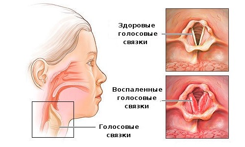 Какие необходимы ингаляции при ларингите?