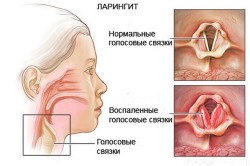 Ларингит Ларингит