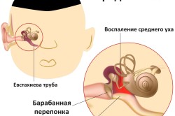 Отит - следствие аденоидита Отит - следствие аденоидита
