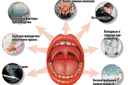 Возможные причины появления фарингита